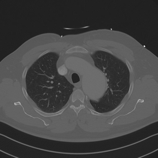 Aortic dissection (Radiopaedia 50763-56234 Axial bone window 35).png