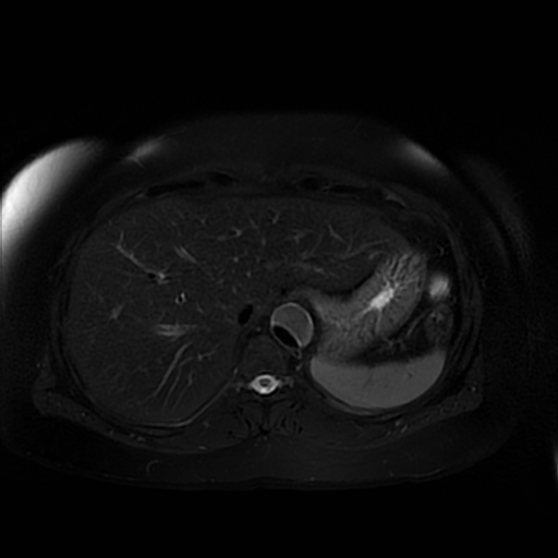 File:Aortic dissection (Radiopaedia 57969-64956 Axial T2 fat sat 17).jpg