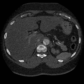 Aortic dissection (Radiopaedia 57969-64959 A 315).jpg