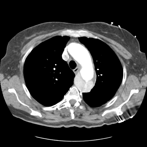 File:Aortic dissection - Stanford type B (Radiopaedia 50171-55512 A 14).png