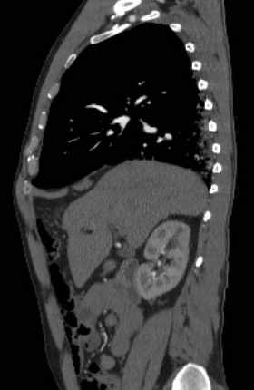 File:Aortic dissection - Stanford type B (Radiopaedia 73648-84437 C 107).jpg