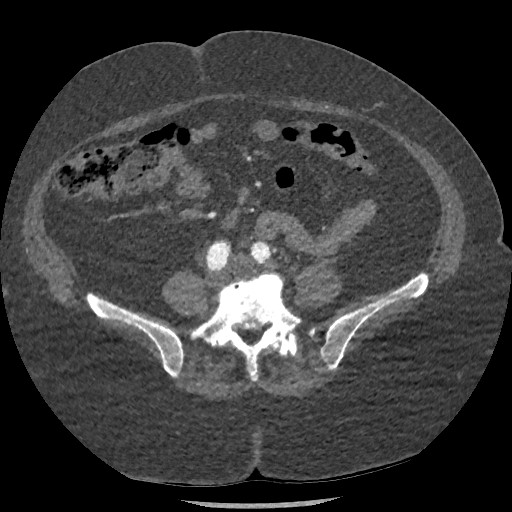 Aortic dissection - Stanford type B (Radiopaedia 88281-104910 A 134).jpg