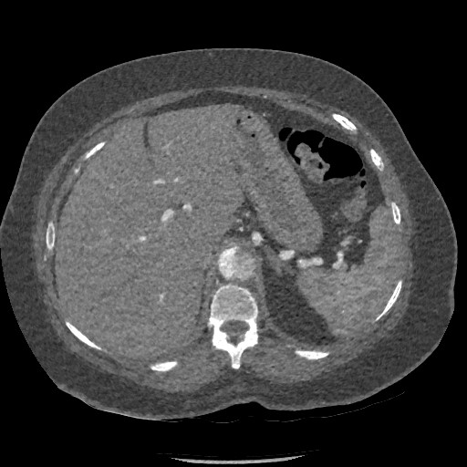 Aortic dissection - Stanford type B (Radiopaedia 88281-104910 A 96).jpg