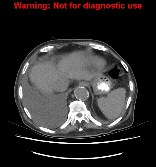 Aortic graft infection (Radiopaedia 44979-48907 Axial non-contrast 21).jpg
