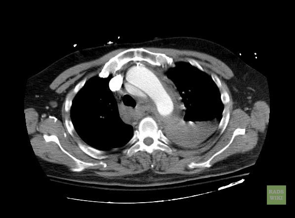 File:Aortic intramural hematoma (Radiopaedia 11198-11562 A 1).jpg