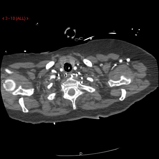 File:Aortic intramural hematoma (Radiopaedia 27746-28001 A 10).jpg