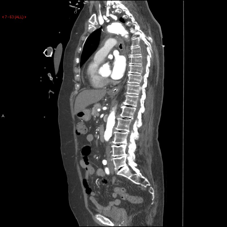 Aortic intramural hematoma (Radiopaedia 27746-28001 C 32).jpg