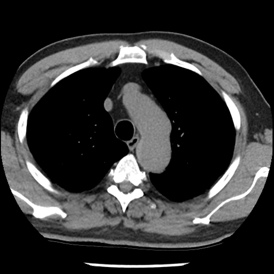 Aortic intramural hematoma (type B) (Radiopaedia 79323-92387 Axial non-contrast 12).jpg