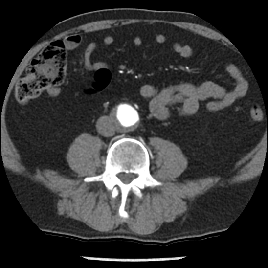 Aortic intramural hematoma (type B) (Radiopaedia 79323-92387 B 81).jpg