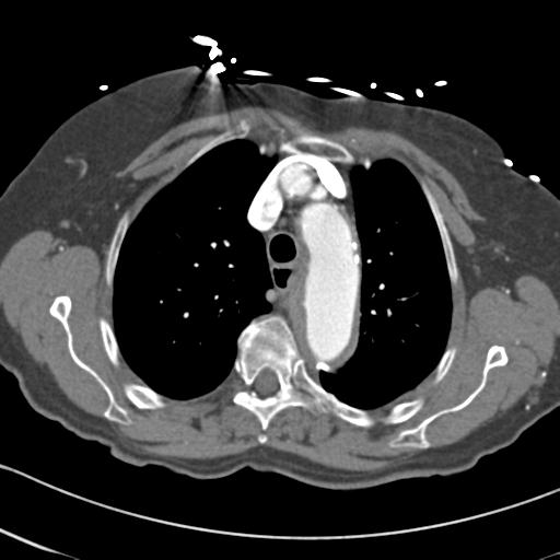 Aortic intramural hematoma from penetrating atherosclerotic ulcer (Radiopaedia 31137-31836 A 21).jpg