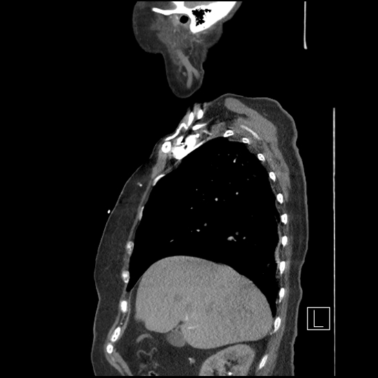Aortic intramural hematoma with dissection and intramural blood pool (Radiopaedia 77373-89491 D 22).jpg