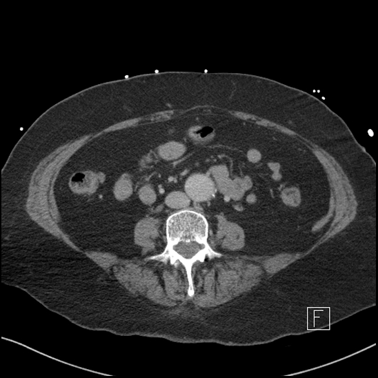 Aortic intramural hematoma with dissection and intramural blood pool (Radiopaedia 77373-89491 E 48).jpg