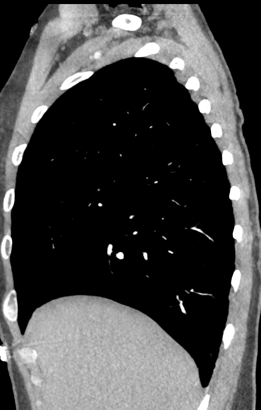 Aortic valve non-coronary cusp thrombus (Radiopaedia 55661-62189 C+ arterial phase 57).png