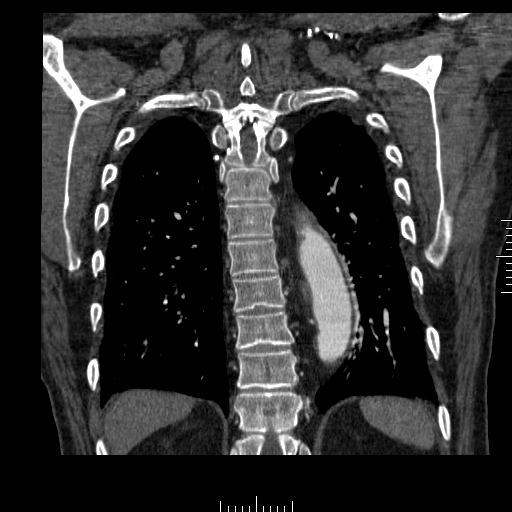 File:Aorto-coronary bypass graft aneurysms (Radiopaedia 40562-43157 B 36).png