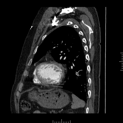 File:Aorto-coronary bypass graft aneurysms (Radiopaedia 40562-43157 C 33).png
