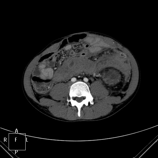 File:Aorto-left renal vein fistula (Radiopaedia 45534-49628 A 44).jpg