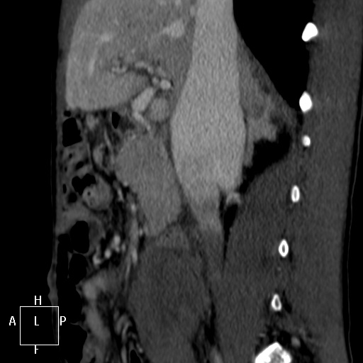 Aorto-left renal vein fistula (Radiopaedia 45534-49628 C 18).jpg