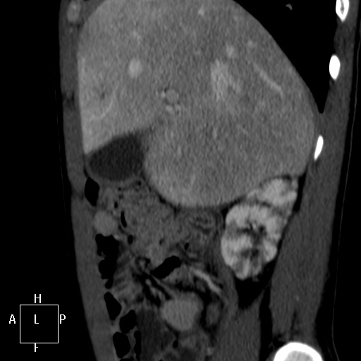 File:Aorto-left renal vein fistula (Radiopaedia 45534-49628 C 2).jpg
