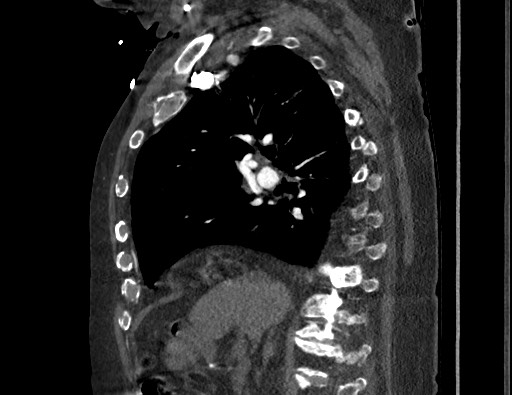 File:Aortoesophageal fistula with endovascular repair (Radiopaedia 73781-84592 Sagittal C+ CTPA 75).jpg