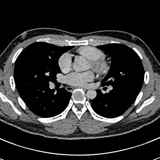 File:Apical lung mass mimic - neurogenic tumor (Radiopaedia 59918-67521 A 43).jpg