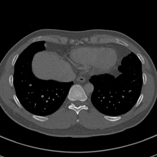 Apical lung mass mimic - neurogenic tumor (Radiopaedia 59918-67521 Axial bone window 63).jpg