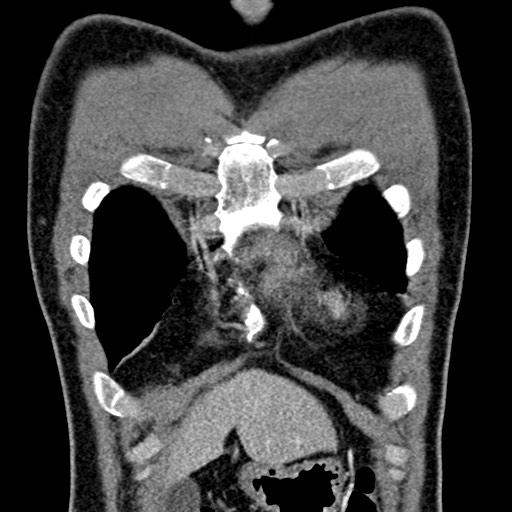 Apical lung mass mimic - neurogenic tumor (Radiopaedia 59918-67521 B 37).jpg
