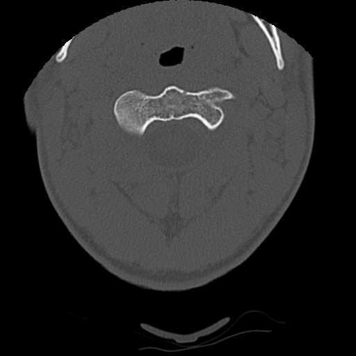 File:Apical pneumothorax on cervical spine CT (Radiopaedia 45343-49368 Axial bone window 21).jpg