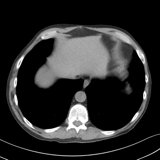 Apical pulmonary metastasis (Radiopaedia 46338-50754 B 52).png