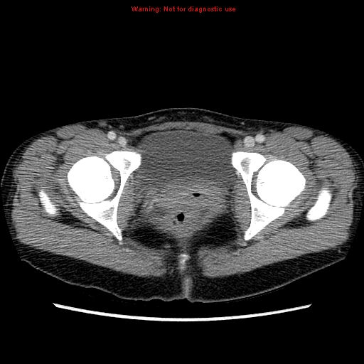 File:Appendiceal abscess (Radiopaedia 13096-13151 A 13).jpg