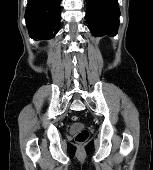 Appendiceal adenocarcinoma complicated by retroperitoneal abscess (Radiopaedia 58007-65039 A 70).jpg