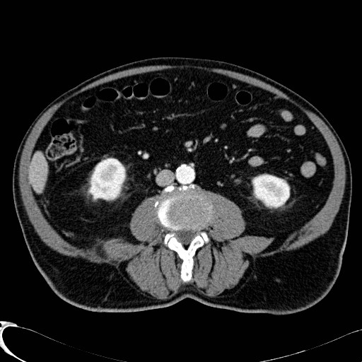 File:Appendiceal adenocarcinoma complicated by retroperitoneal abscess (Radiopaedia 58007-65039 B 74).jpg