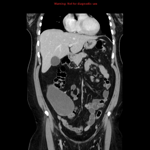Appendiceal mucinous cystadenoma (Radiopaedia 8263-9111 B 26).jpg