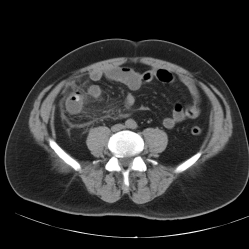 File:Appendicitis and giant appendicolith (Radiopaedia 80251-93588 Axial non-contrast 36).jpg