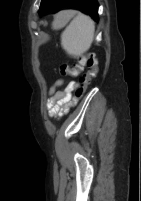 Appendicitis due to chicken fibula (Radiopaedia 74314-85198 C 88).jpg