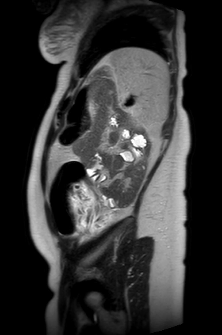 Appendicitis in gravida (MRI) (Radiopaedia 89433-106395 Sagittal T2 14).jpg