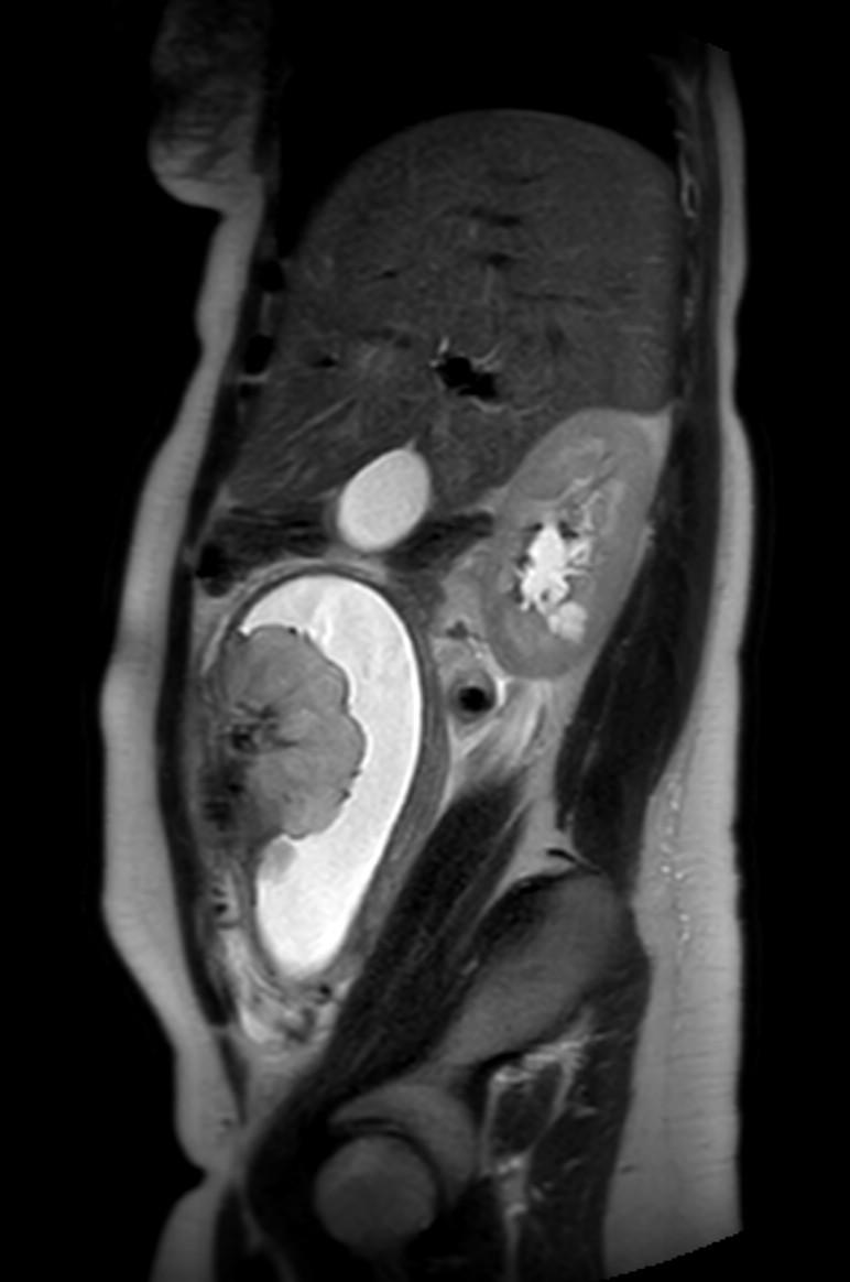 Appendicitis in gravida (MRI) (Radiopaedia 89433-106395 Sagittal T2 46).jpg