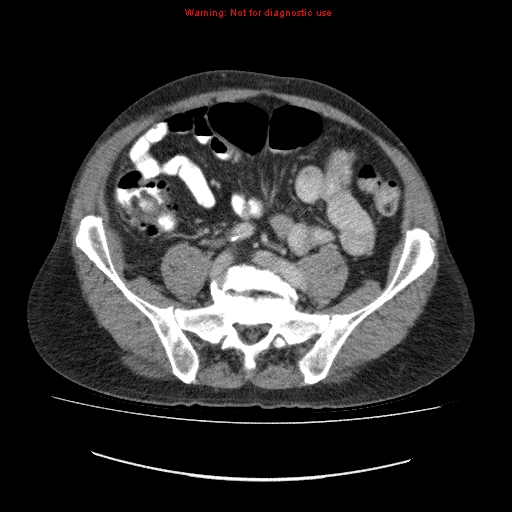 File:Appendicitis mass in inguinal hernia (Radiopaedia 26858-27029 A 5).jpg