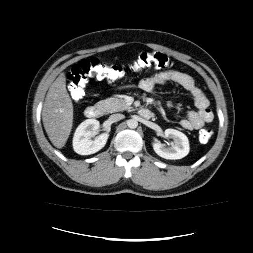 Appendicitis with diverticulosis (Radiopaedia 47693-52383 Axial C+ 53).jpg