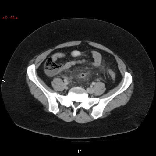 Appendicitis with microperforation- promontoric type (Radiopaedia 27268-27442 C 54).jpg