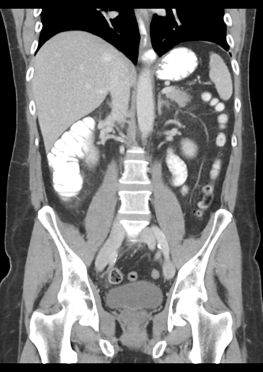 Appendicitis with thickening of the terminal ileum (Radiopaedia 42432-45550 B 34).png