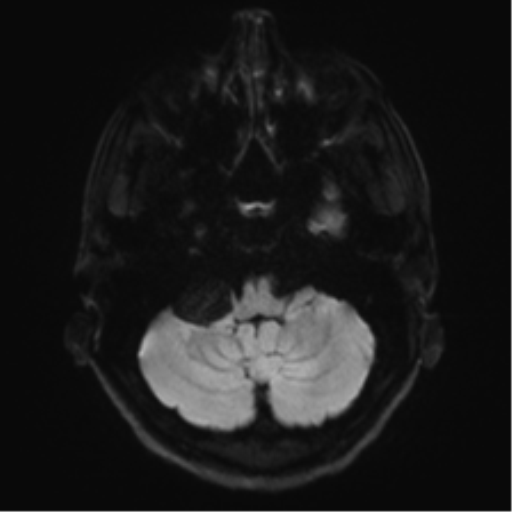 Arachnoid cyst - cerebellopontine angle (Radiopaedia 59689-67083 Axial DWI 43).png