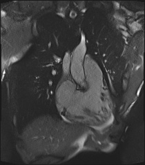 File:Arrhythmogenic right ventricular cardiomyopathy (Radiopaedia 57972-64966 CINE R2 SSFP 74).jpg
