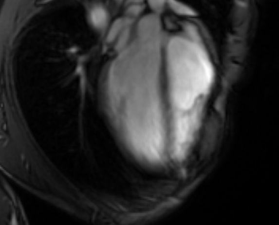 Arrhythmogenic right ventricular cardiomyopathy (Radiopaedia 69564-79464 4ch cine 39).jpg