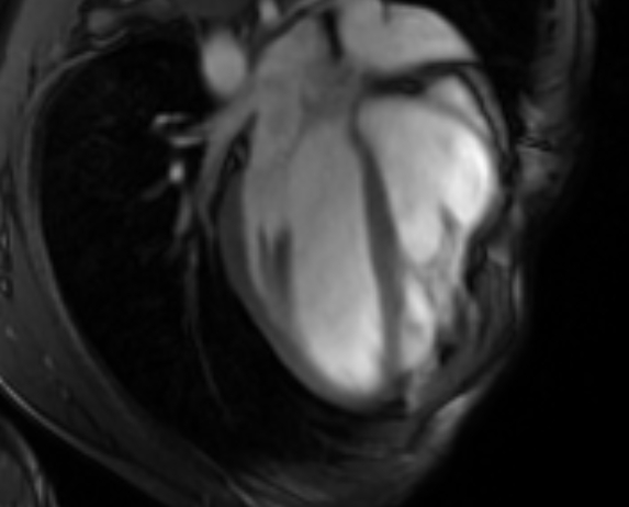 Arrhythmogenic right ventricular cardiomyopathy (Radiopaedia 69564-79464 4ch cine 42).jpg