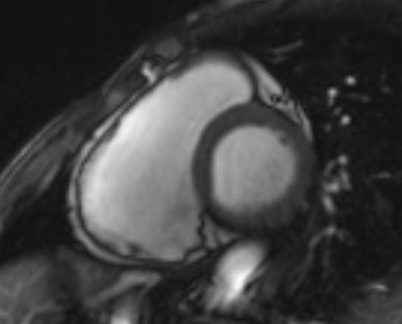 Arrhythmogenic right ventricular cardiomyopathy (Radiopaedia 69564-79464 short axis cine 184).jpg
