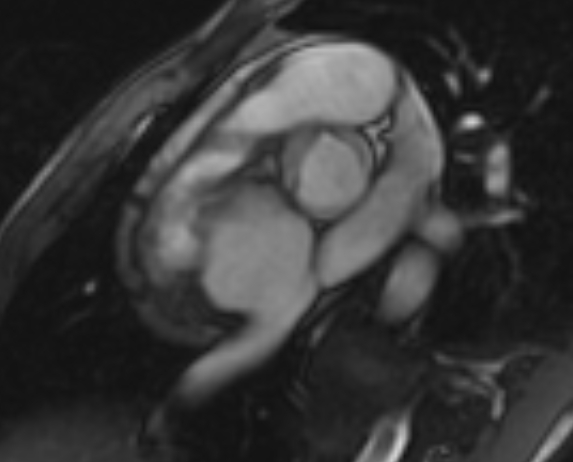 Arrhythmogenic right ventricular cardiomyopathy (Radiopaedia 69564-79464 short axis cine 262).jpg