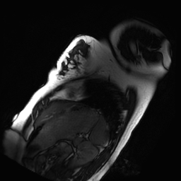 Arrhythmogenic right ventricular cardiomyopathy (Radiopaedia 87505-103850 short axis Cine SSFP 4).jpg