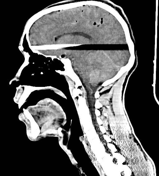 Arrow injury to the brain (Radiopaedia 72101-82607 H 31).jpg