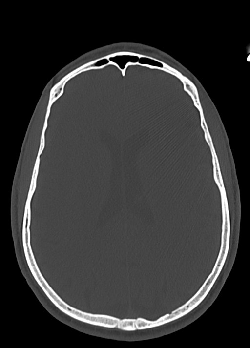 Arrow injury to the head (Radiopaedia 75266-86388 Axial bone window 81).jpg