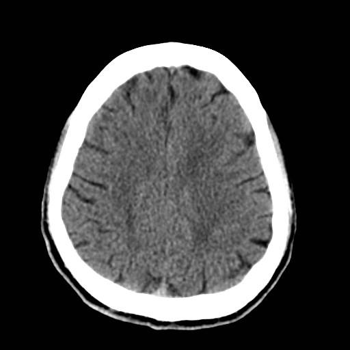 File:Artery of Percheron infarct (Radiopaedia 48088-52893 Axial non-contrast 29).jpg
